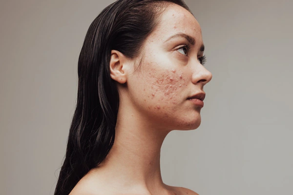 Młoda kobieta ze skórą z niedoskonałościami na jasnym tle.